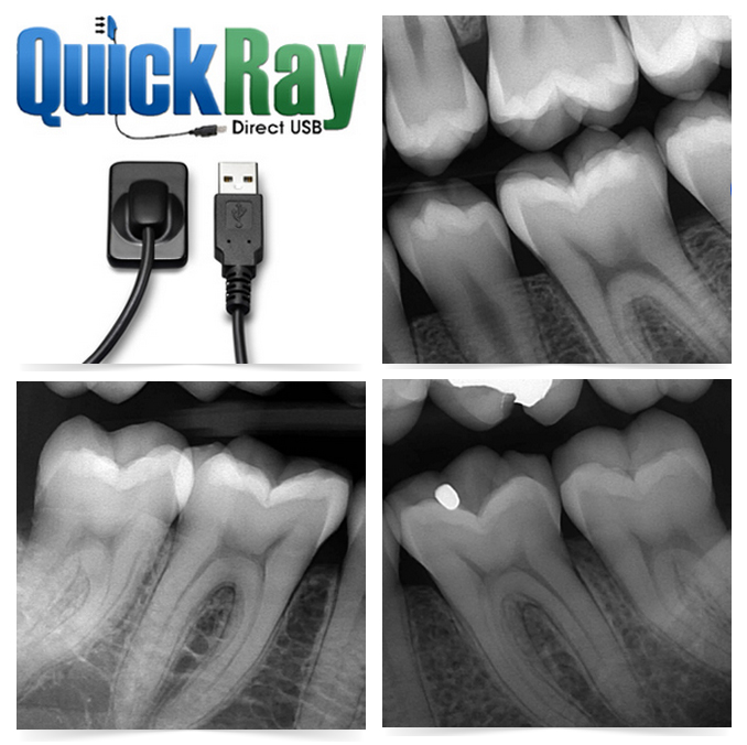 QuickRay - Dental X-Ray Sensor - Direct USB - Size 1 - Click Image to Close