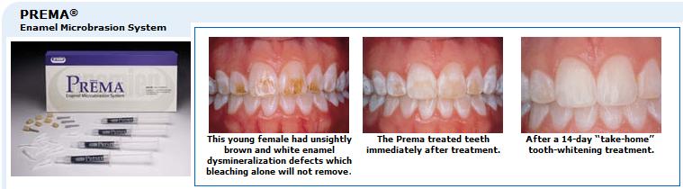 (image for) Prema - Enamel Microabrasion System